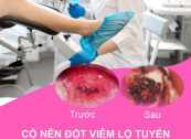 Ám ảnh video thực tế quá trình đốt điện viêm lộ tuyến cổ tử cung