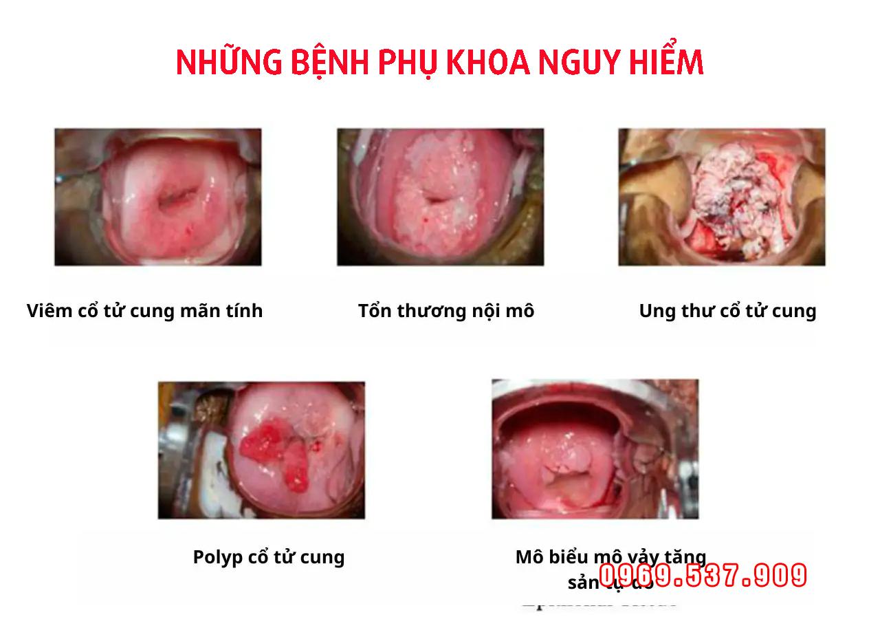 NHỮNG BỆNH PHỤ KHOA NGUY HIỂM