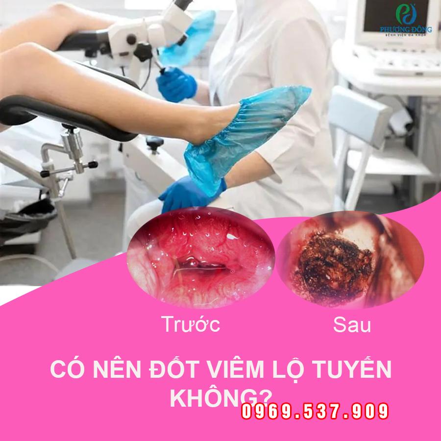 Video Đốt Viêm Lộ Tuyến Cổ Tử Cung: Quy Trình, Lợi Ích Và Những Điều Cần Biết