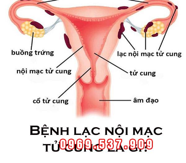 bênh lac nội mạc tử cung