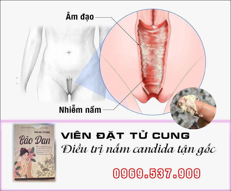 Cách chữa vùng kín ngứa có dịch trắng