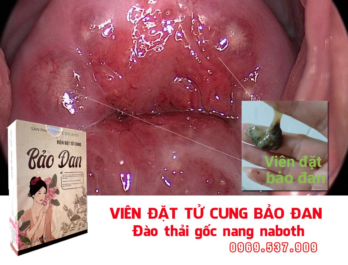 chữa nang naboth bằng thuốc nam