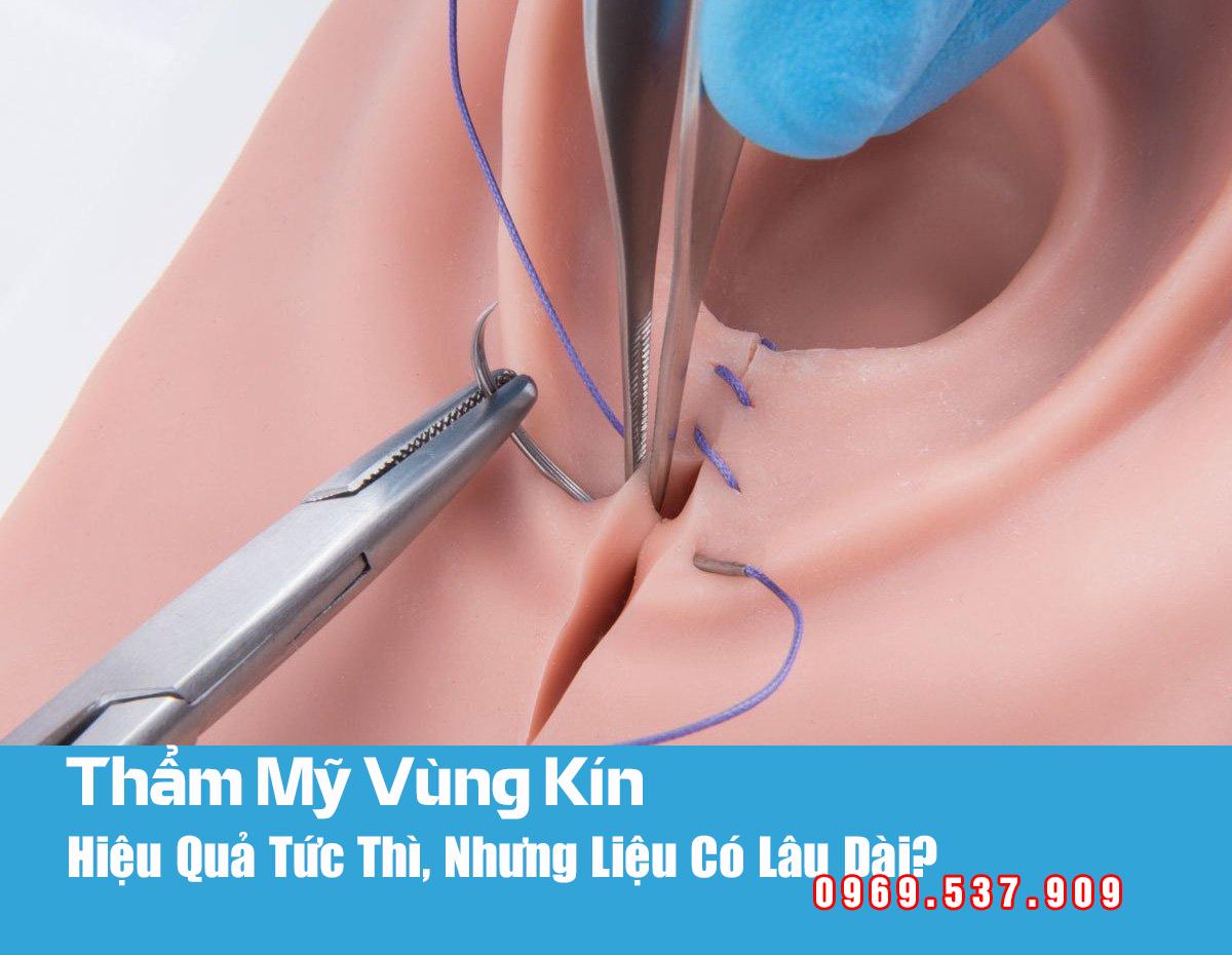 thẩm mỹ vùng kín