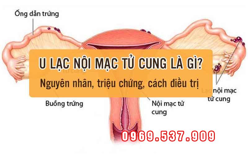 lạc nội mạc tử cung