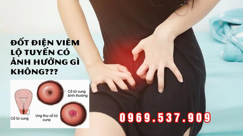 đốt viêm lộ tuyến