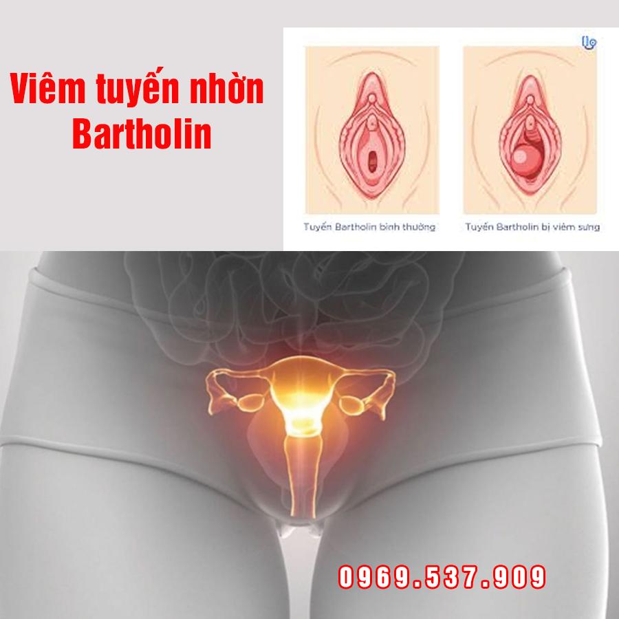 viêm tuyến nhờn bartholin