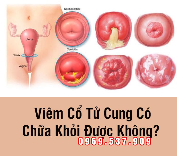 hình ảnh viêm lộ tuyến diện rộng