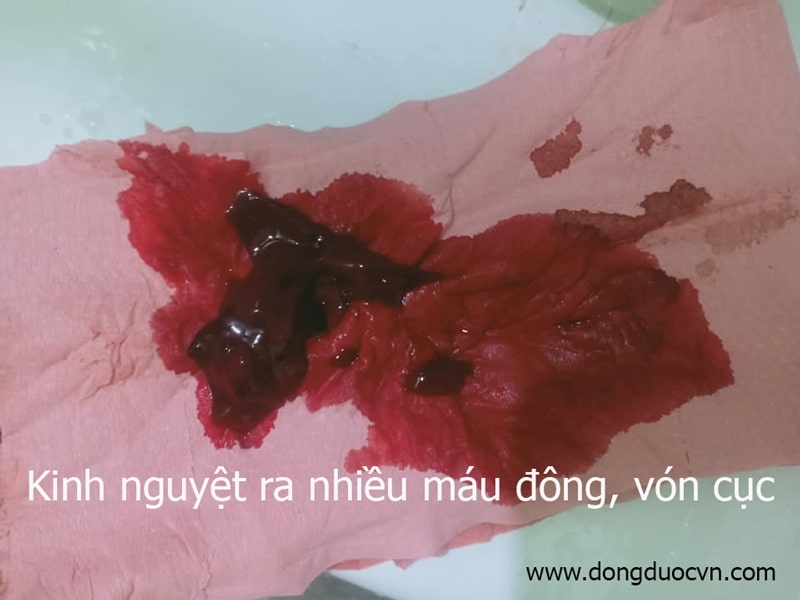 Triệu chứng và dấu hiệu của máu đông trong kinh nguyệt